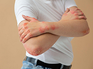 Homoeopathic remedies for treating fungal infection