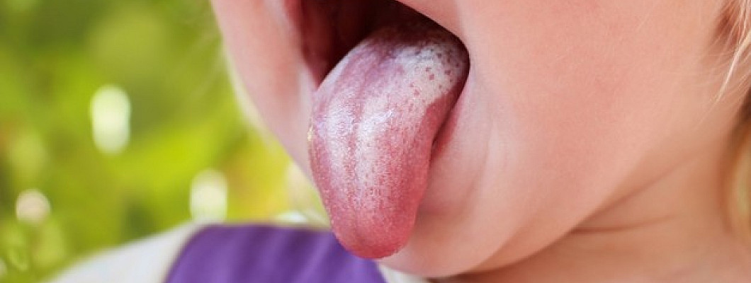 Homeopathy Medicine For Candida