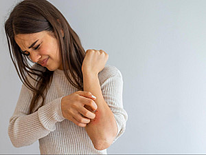 Homeopathy for Psoriasis: A Gentle Approach to Skin Health