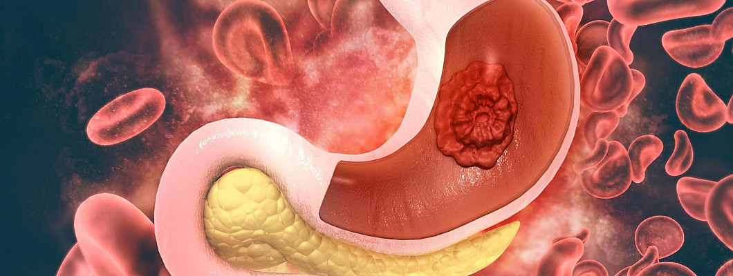 How to treat fatty liver with homeopathy