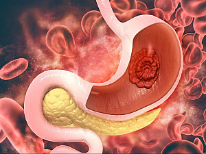 How to treat fatty liver with homeopathy