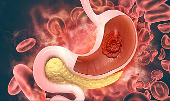 How to treat fatty liver with homeopathy