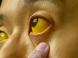 Jaundice Understanding, Treating, and Preventing This Common Health