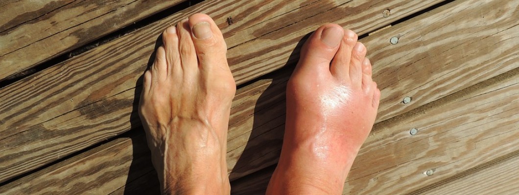Homeopathy for Gout Pain Therapy