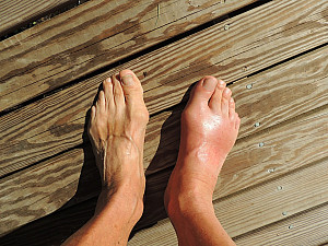 Homeopathy for Gout Pain Therapy