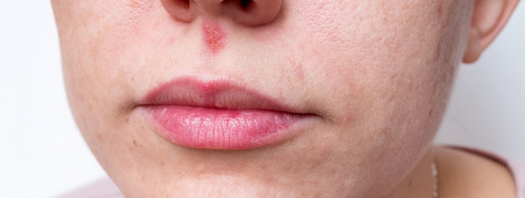 Homeopathy medicines For Cold Sores