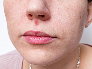 Homeopathy medicines For Cold Sores
