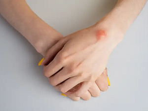 Treatment of Lipoma with Homeopathy