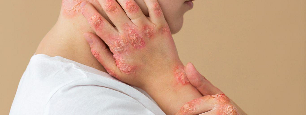 Homeopathic treatment: Psoriasis