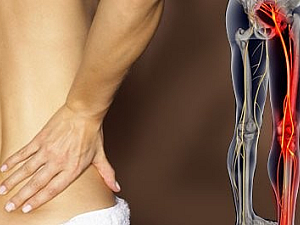 Homeopathic Medicine for Sciatica