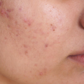  acne pimple