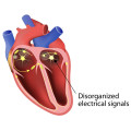  Cardiac Arrythemias