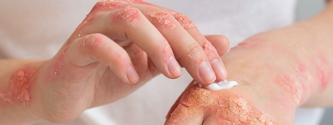 Skin Disease and their Homeopathic Treatment