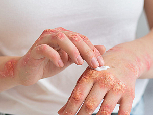 Skin Disease and their Homeopathic Treatment